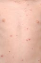 Chickenpox Royalty Free Stock Photo