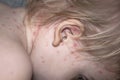 Chickenpox disease. Chickenpox virus, chicken pox outbreak in children. Concept of contagion