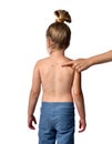 Chickenpox disease pimples on baby girl back and shoulders. Chicken pox virus outbreak in children. Concept of contagion Royalty Free Stock Photo