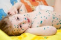 Chickenpox illness