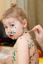 Chickenpox illness