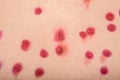 Chickenpox rash on the body