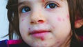 Chickenpox rash close up red dots skin condition on children face details pus