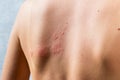 chickenpox rash. Shingles, varicella-zoster virus. skin rash and blisters on body. Skin infected Herpes zoster virus Royalty Free Stock Photo