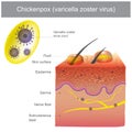 Chickenpox varicella zoster virus.