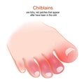 Chilblains . Humans foot with red or swollen toes