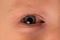 Child with allergy, conjunctivitis his eyes. Sick little boy. Cl Royalty Free Stock Photo