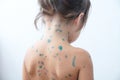 Child back neck with chickenpox. Sick little girl with varicells making eruption on skin. Long home quarantine