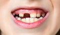 Child bad teeth. Boy kid lost front tooth, toothache. Child without one front tooth. No teeth. Yellow teeth. Bad dental Royalty Free Stock Photo