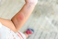 He child bit a mosquito in the arm, itches, redness, a wound Royalty Free Stock Photo