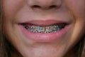 Child with braces Royalty Free Stock Photo