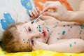 Child with chickenpox