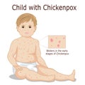 Child with Chickenpox