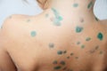 Child dorsum with chickenpox. Sick little girl with varicells making eruption on skin. Long home quarantine Royalty Free Stock Photo