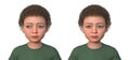 A child with exotropia and the same healthy person, 3D illustration