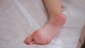 Child foot with red itchy rash closeup