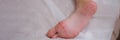 Child foot with red itchy rash closeup Royalty Free Stock Photo