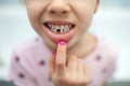 A child girl shows her mouth without one missing tooth in close-up. Lost first milk tooth Royalty Free Stock Photo