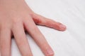 Child hand witn eczema, atopic dermatitis between fingers Royalty Free Stock Photo