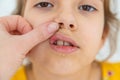 The child has stomatitis on the lip. Selective focus. Royalty Free Stock Photo