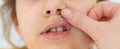 The child has stomatitis on the lip. Selective focus. Royalty Free Stock Photo