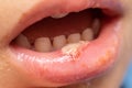 Child having a swollen lower lip winth an infection with pus, causing mouth ulcers Royalty Free Stock Photo