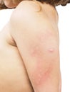 Child with hive, rash, skin abnormality towards white Royalty Free Stock Photo