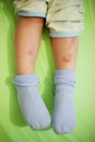 Child legs with bruises