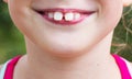 Child with malocclusion