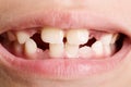 Child missing front teeth