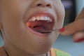 Child patient Check the tonsil by doctor in hospital