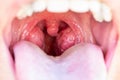 The child is a patient with large red glands. Tonsils in close-up in the mouth.