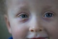Child with purulent conjunctivitis, contagious eye infection. Symptoms and treatment concept. Close up Royalty Free Stock Photo