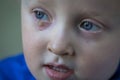 Child with purulent conjunctivitis, contagious eye infection. Symptoms and treatment concept. Close up Royalty Free Stock Photo