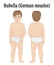 A child with rubella