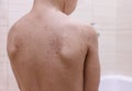 Child`s back. Eczema atopic dermatitis symptom skin. Symptom. Royalty Free Stock Photo