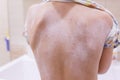 Child`s back. Eczema atopic dermatitis symptom skin. Emollient cream Royalty Free Stock Photo