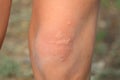 The child`s knee burned with nettle grass. Type of burn