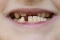 Child`s mouth close-up, tooth growth and lack thereof Royalty Free Stock Photo