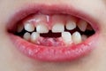 Child`s mouth with two anterior lower milk teeth pulled out