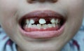 Child`s smiley mouth with missing milk tooth Royalty Free Stock Photo