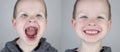 Before and after. The child shows the damaged teeth by caries, and in the second picture the dentist`s work on the restoration of