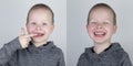 Before and after. The child shows the damaged teeth by caries, and in the second picture the dentist`s work on the restoration of