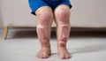 A child with skin conditions stands on a white carpet