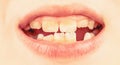 Child smile and show her crowding tooth. Close up of unhealthy baby teeths. Kid patient open mouth showing cavities