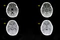 a child with subdural hematoma