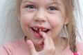 Child touching her staggering upper tooth next to lost one