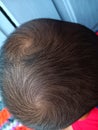 a child with two hair whorls