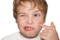 Child in white finger indicates pimple