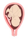 Child in the womb. The detachment of the placenta, placental abruption. Vaginal bleeding. Dangerous complication of pregnancy Royalty Free Stock Photo